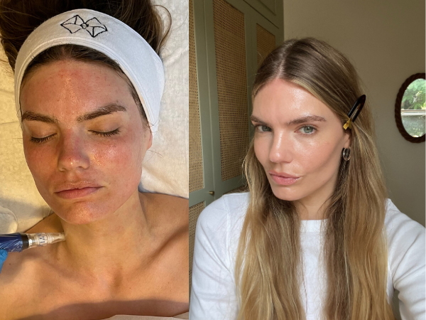 split image of woman having microneedling and then after