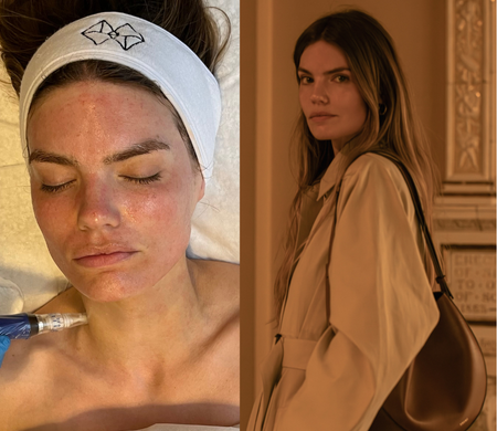 split image of woman having microneedling and then after